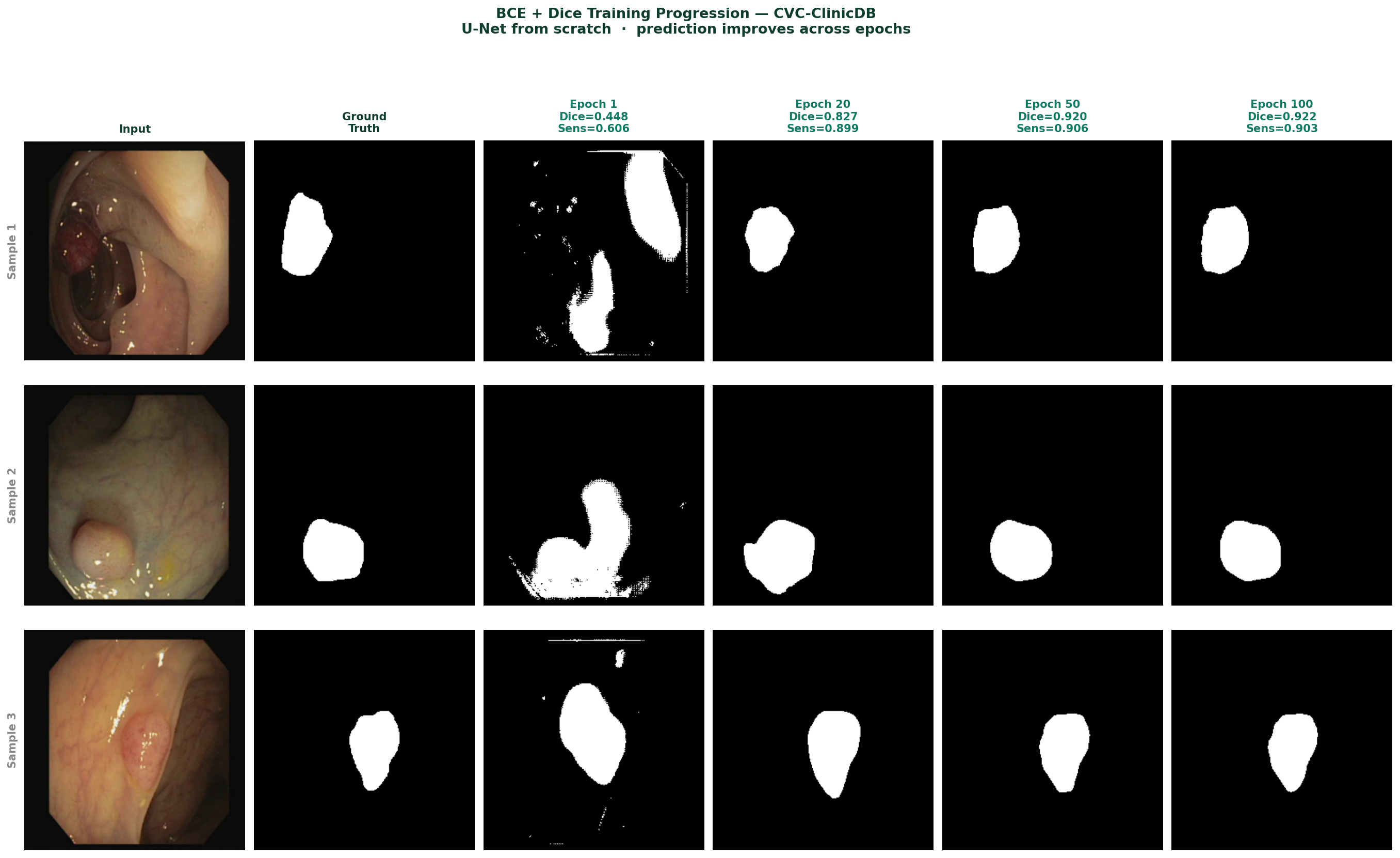 Figure 4 — BCE+Dice prediction progression at epochs 1, 20, 50, 100